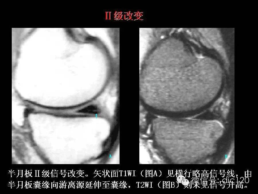 半月板和韧带MRI诊断