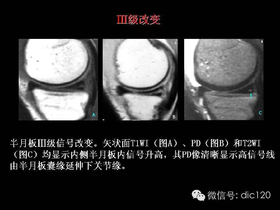 半月板和韧带MRI诊断