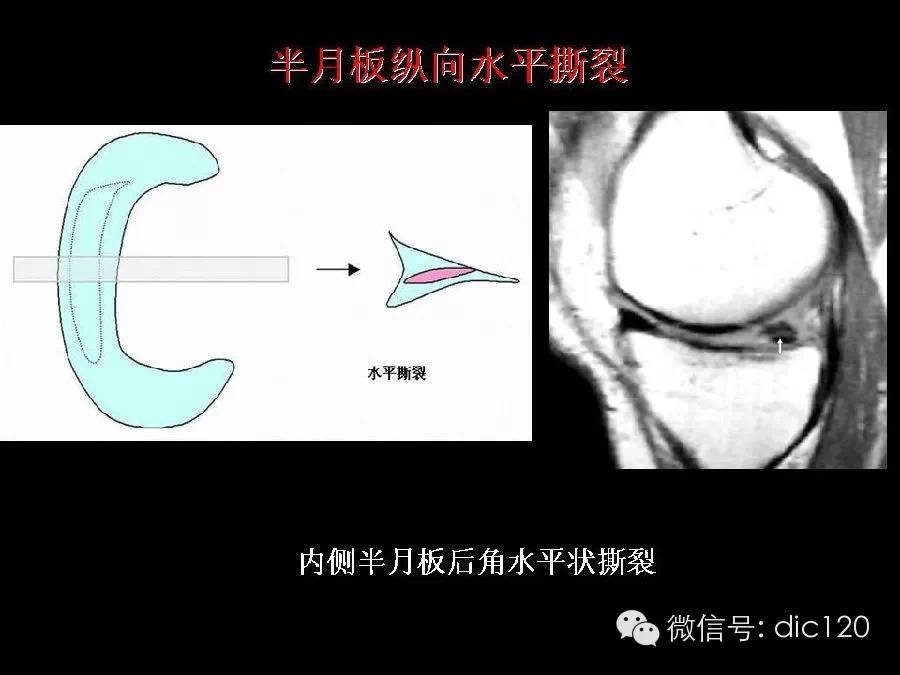 半月板和韧带MRI诊断