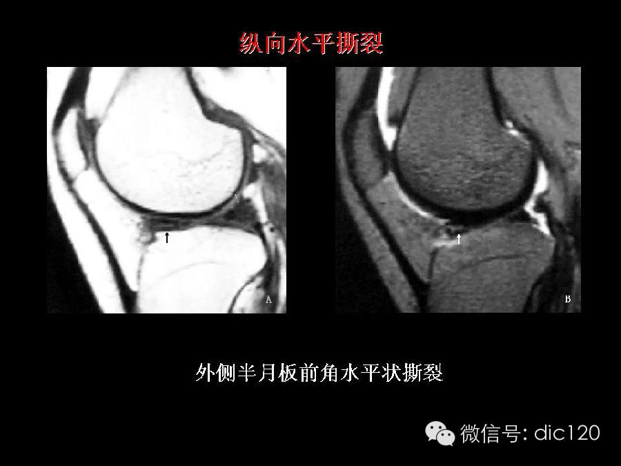 半月板和韧带MRI诊断