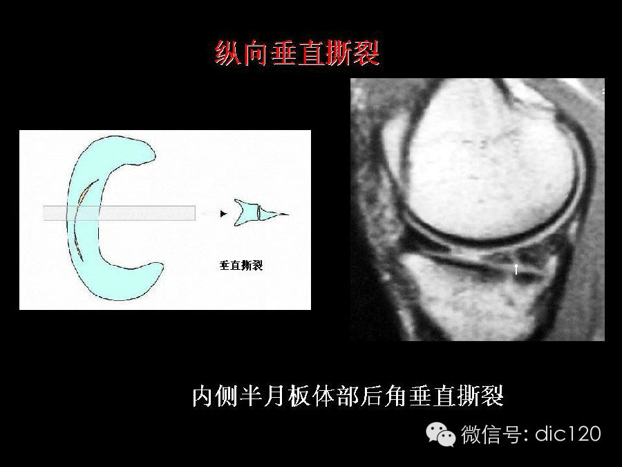 半月板和韧带MRI诊断