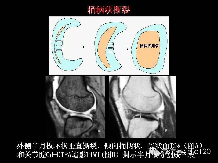 半月板和韧带MRI诊断