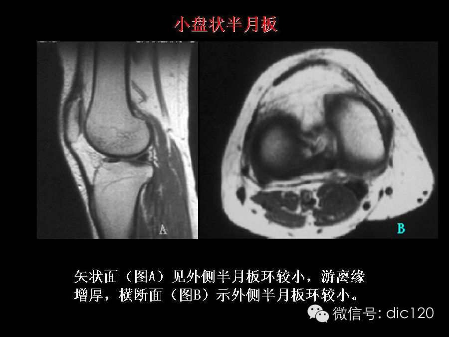 半月板和韧带MRI诊断