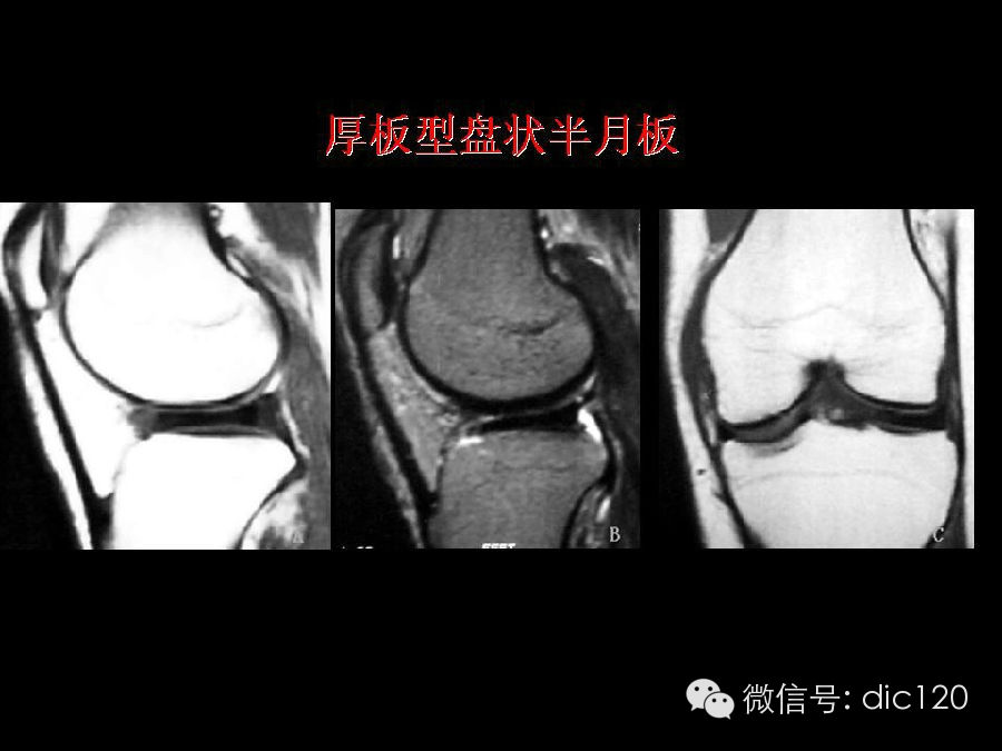 半月板和韧带MRI诊断