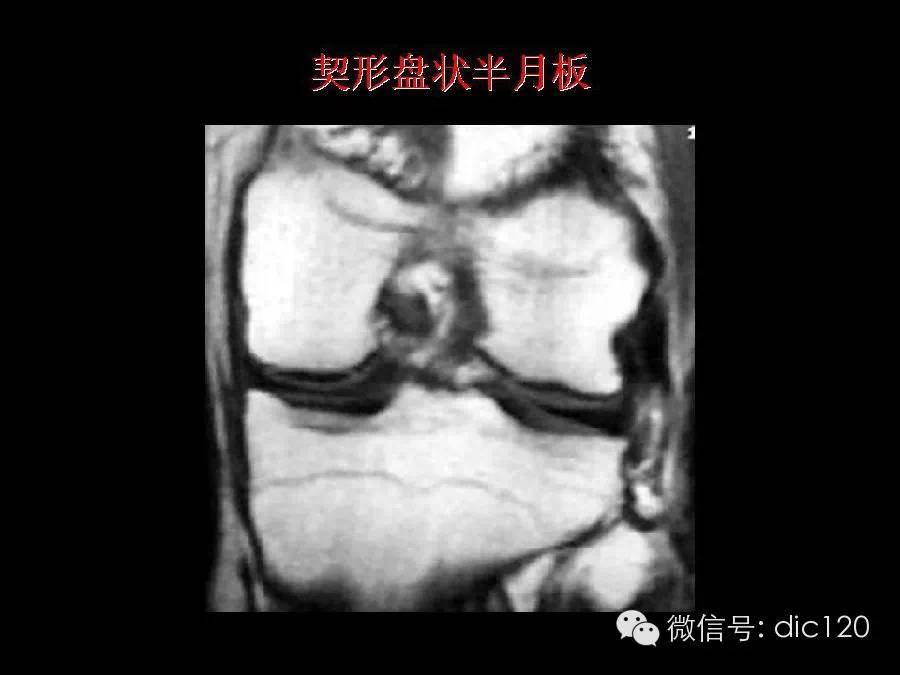 半月板和韧带MRI诊断