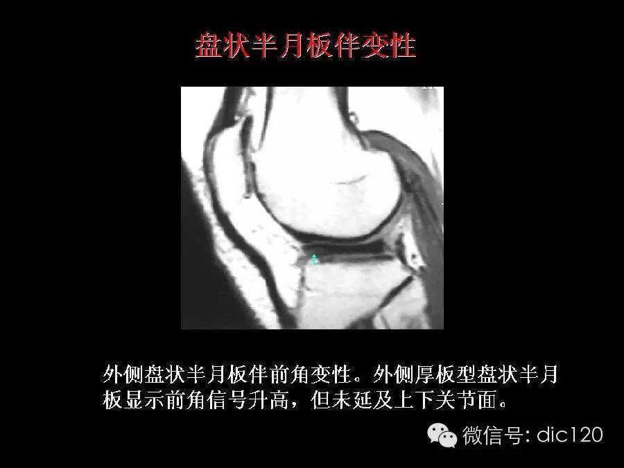 半月板和韧带MRI诊断