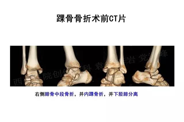 多发骨折（股骨干及近端骨折、肱骨干骨折、踝骨骨折）