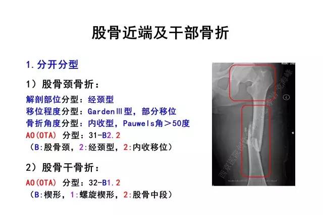 多发骨折（股骨干及近端骨折、肱骨干骨折、踝骨骨折）