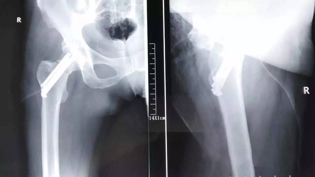 股骨颈骨折DAA入路骨折复位+空心钉内固定
