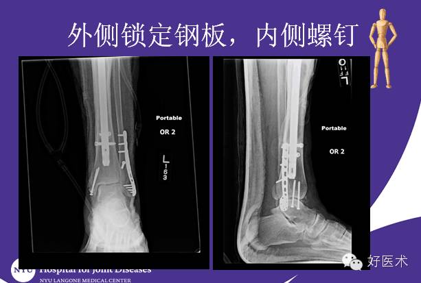 【完结篇】国际上踝关节骨折治疗的案例分析
