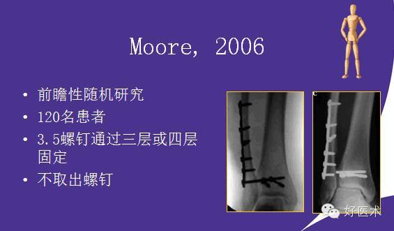 【2】国际上踝关节骨折治疗的案例分析