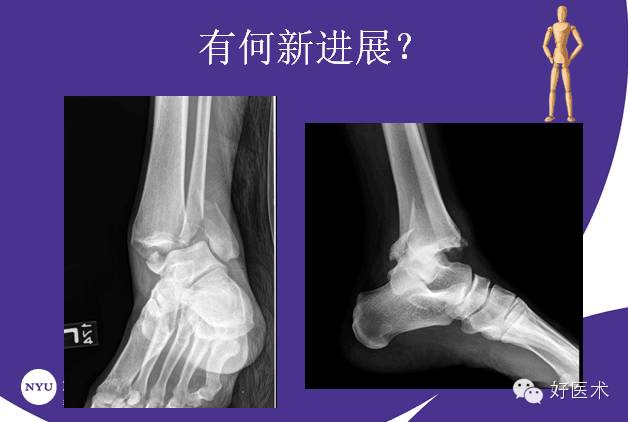【1】国际上踝关节骨折治疗的案例分析