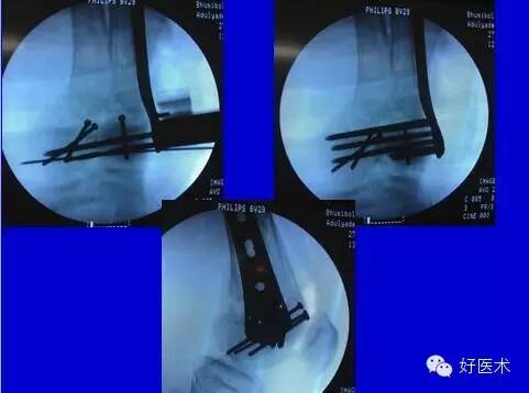股骨远端骨折的微创接骨术之手术技巧
