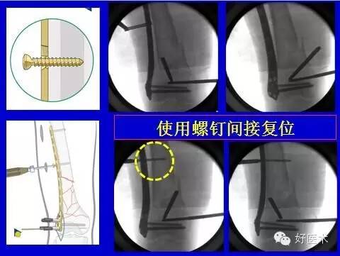 股骨远端骨折的微创接骨术之手术技巧