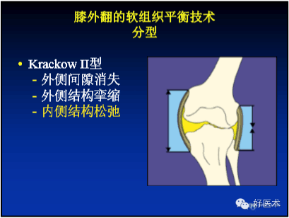 一个PPT让你掌握膝外翻的治疗方法