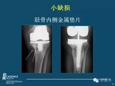 TKA翻修术中严重骨缺损和软组织失衡的处理