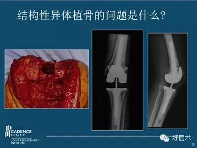 TKA翻修术中严重骨缺损和软组织失衡的处理