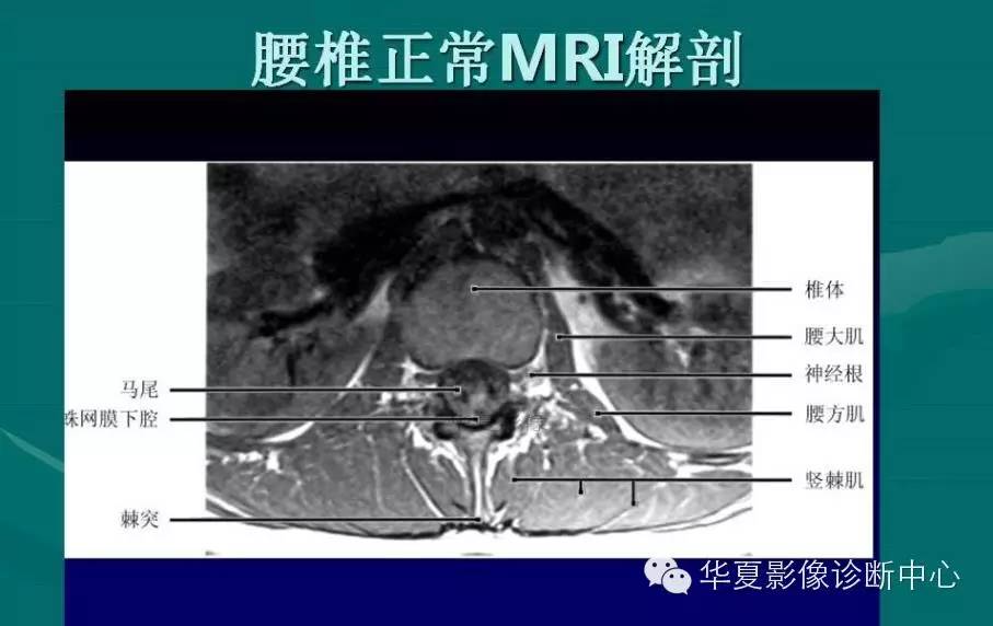 腰椎间盘病变的MRI诊断