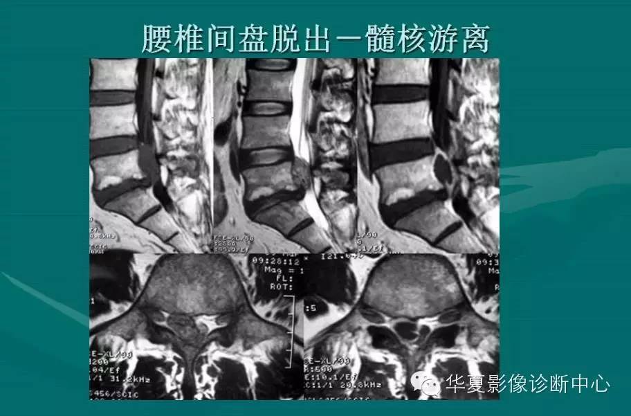 腰椎间盘病变的MRI诊断