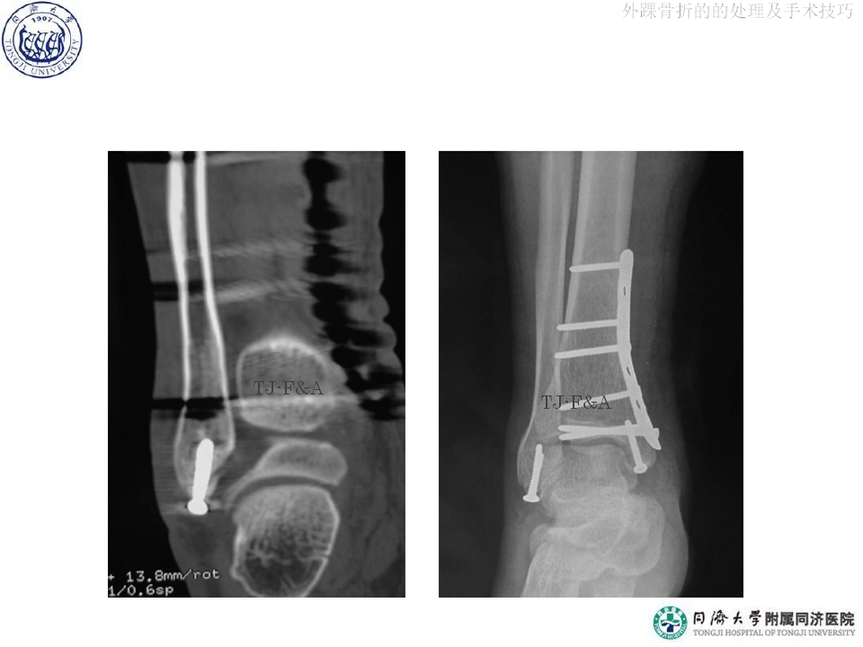俞光荣-外踝骨折的的处理及手术技巧