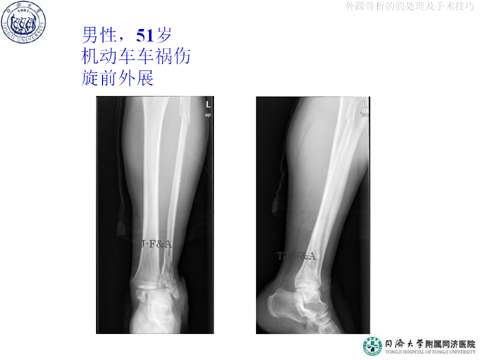 俞光荣-外踝骨折的的处理及手术技巧