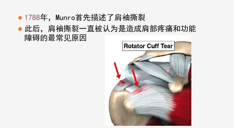 肩袖损伤分型、诊断以及缝合方法