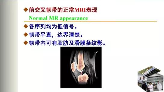 前交叉韧带损伤的MRI诊断