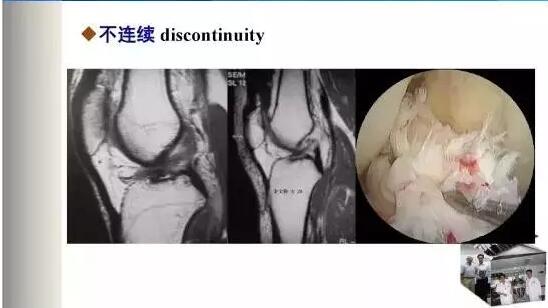 前交叉韧带损伤的MRI诊断