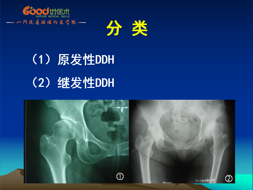 髋臼发育不良(DDH)手术策略