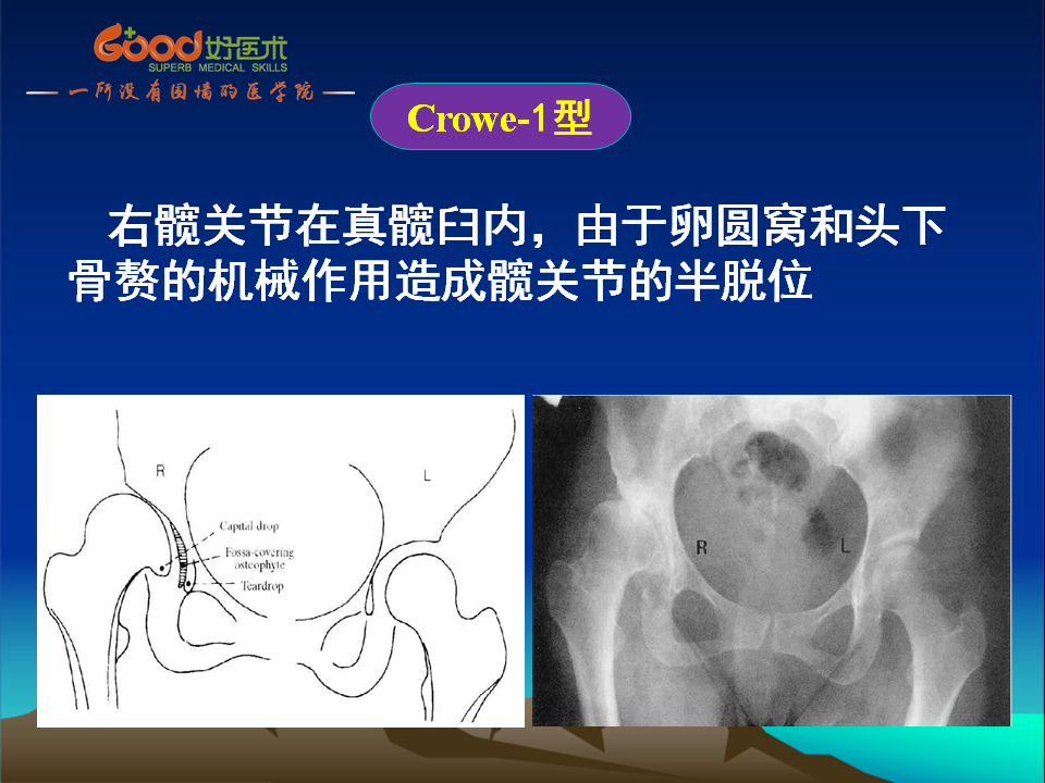 髋臼发育不良(DDH)手术策略