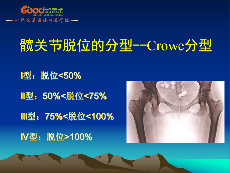 髋臼发育不良(DDH)手术策略