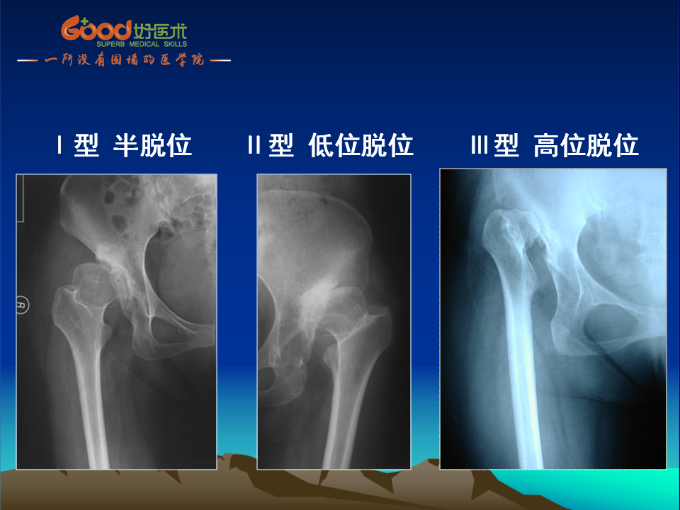 髋臼发育不良(DDH)手术策略