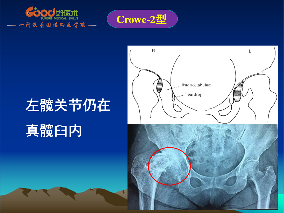 髋臼发育不良(DDH)手术策略