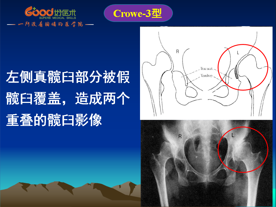 髋臼发育不良(DDH)手术策略