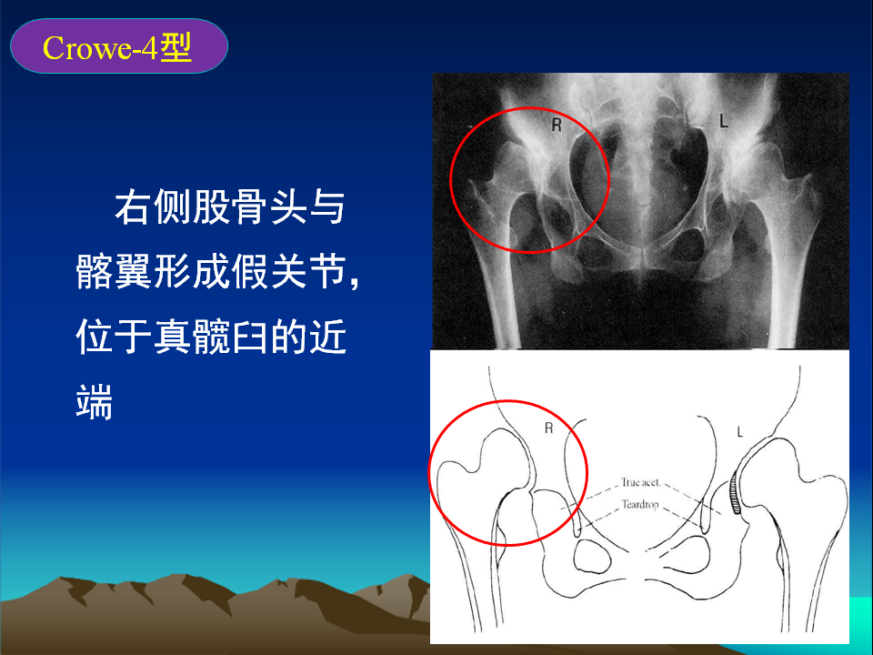 髋臼发育不良(DDH)手术策略