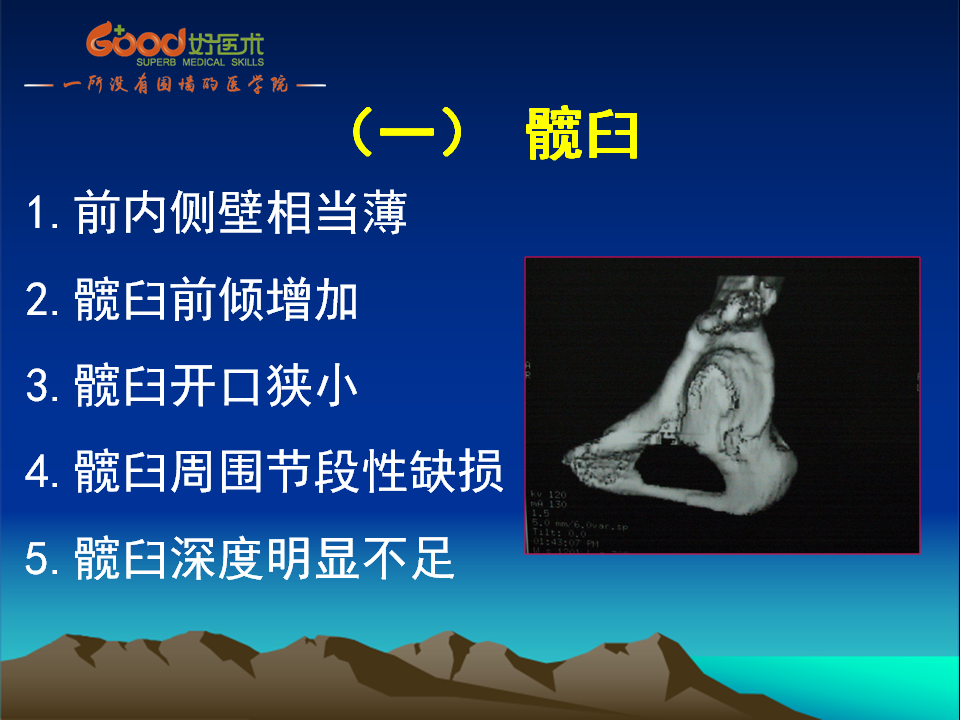 髋臼发育不良(DDH)手术策略