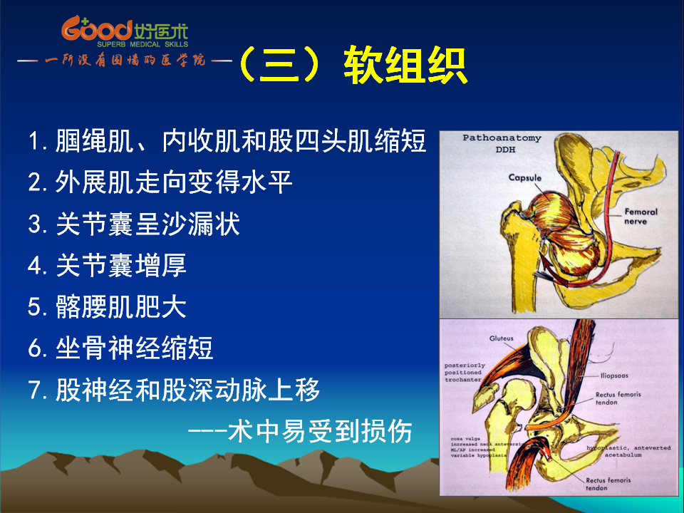 髋臼发育不良(DDH)手术策略