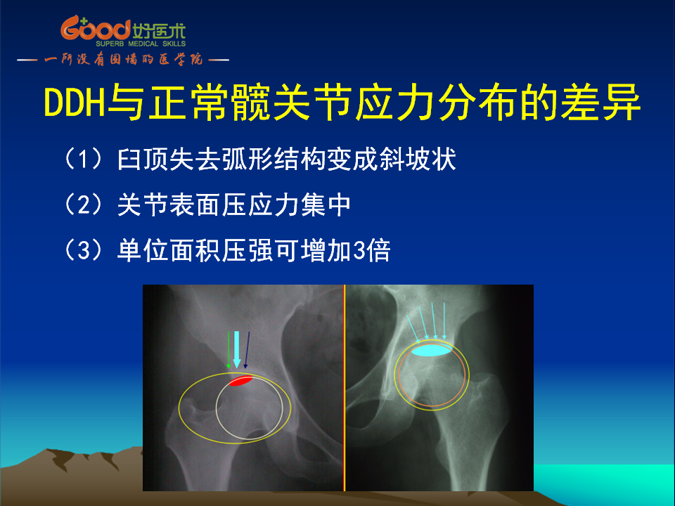 髋臼发育不良(DDH)手术策略