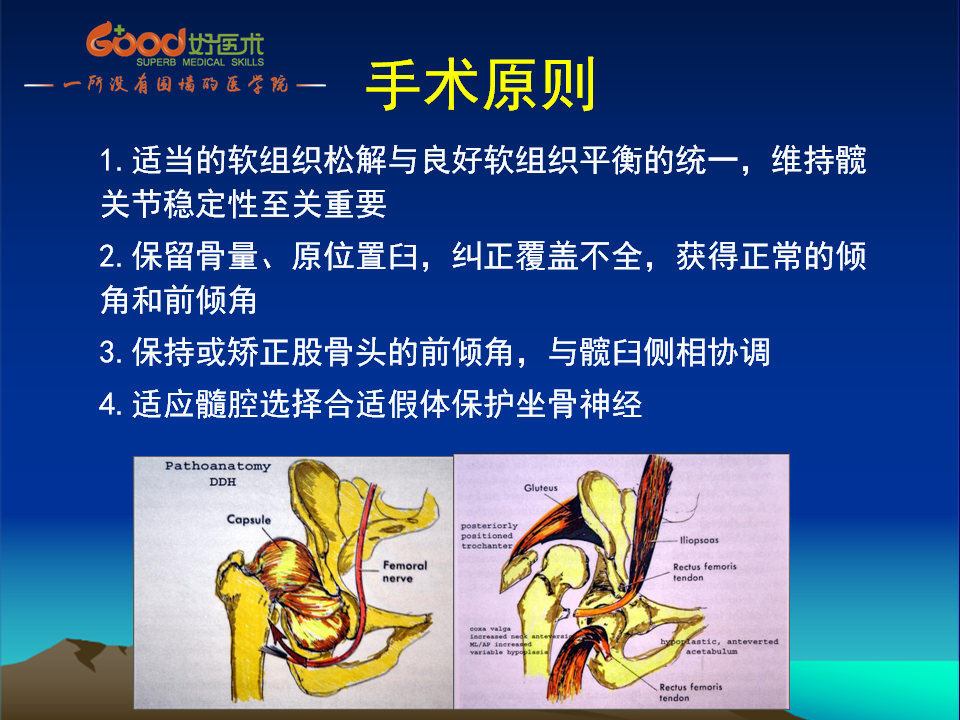 髋臼发育不良(DDH)手术策略