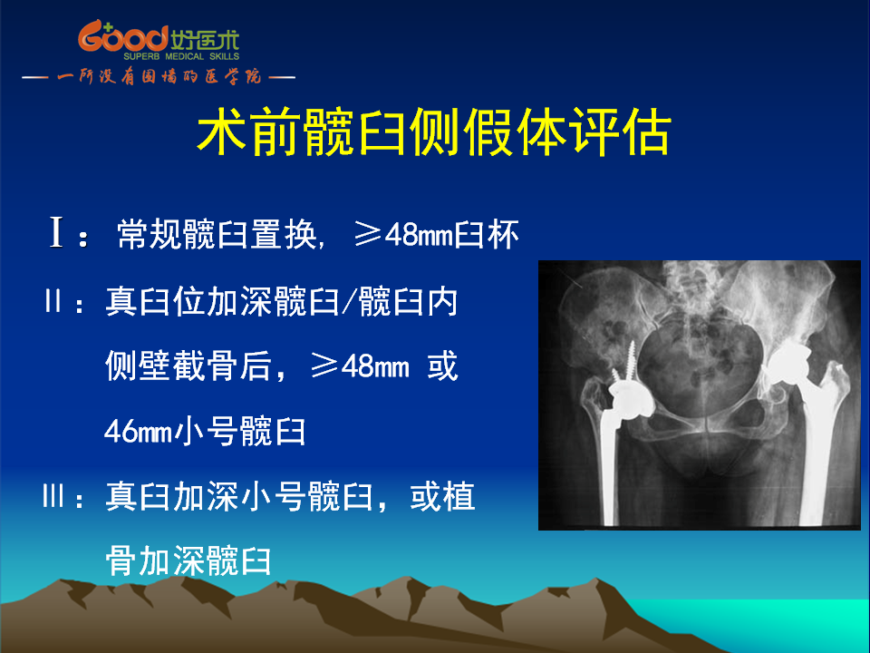 髋臼发育不良(DDH)手术策略