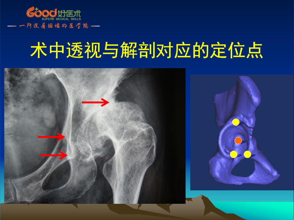 髋臼发育不良(DDH)手术策略