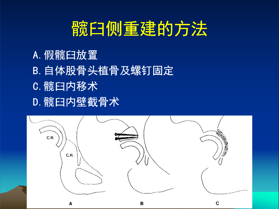 髋臼发育不良(DDH)手术策略