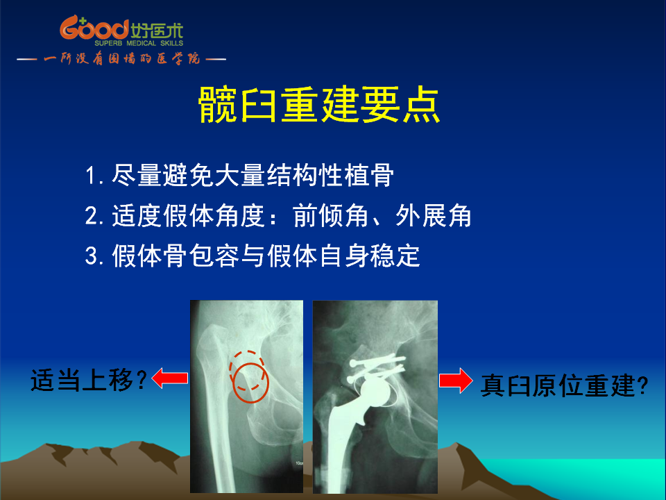 髋臼发育不良(DDH)手术策略