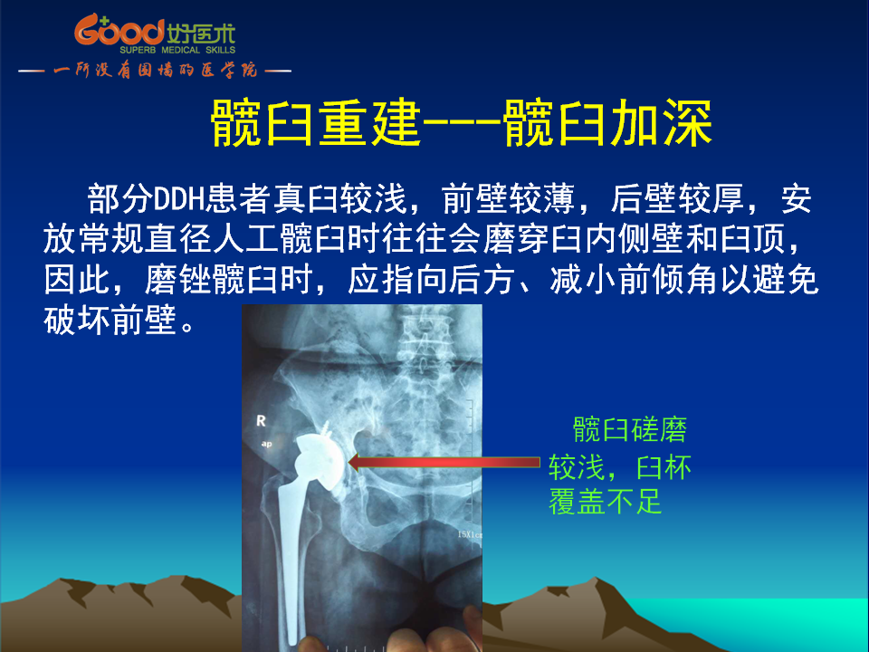 髋臼发育不良(DDH)手术策略