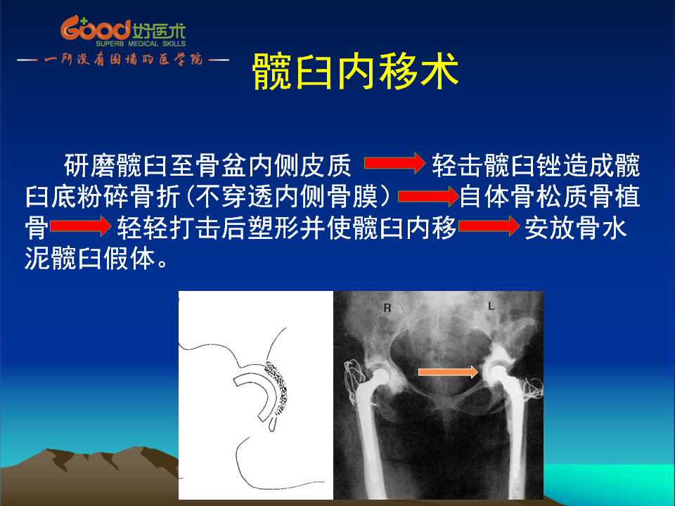 髋臼发育不良(DDH)手术策略