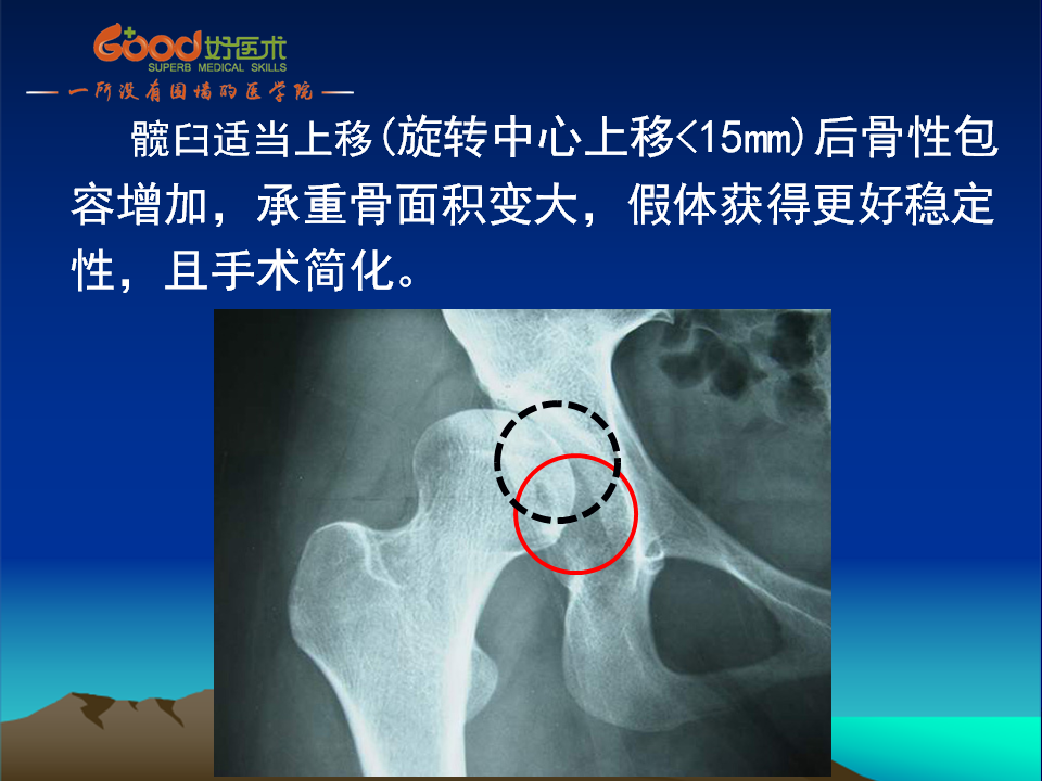 髋臼发育不良(DDH)手术策略