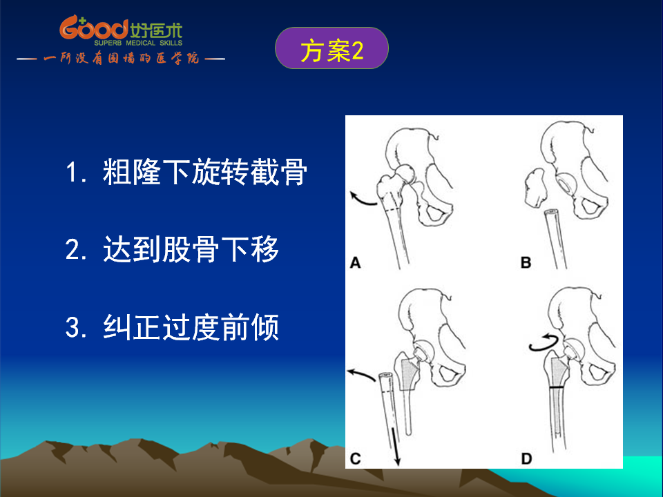 髋臼发育不良(DDH)手术策略