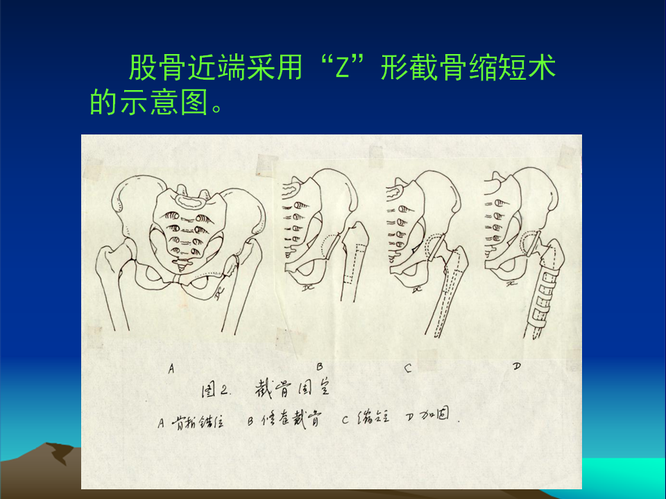 髋臼发育不良(DDH)手术策略