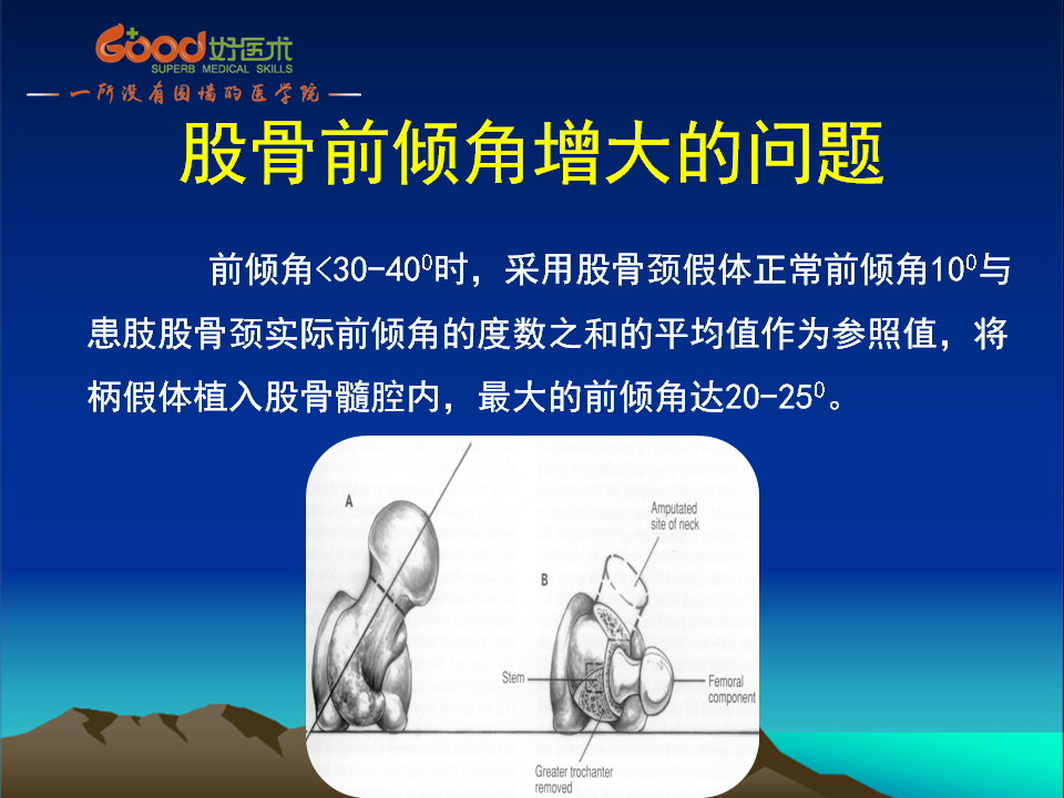 髋臼发育不良(DDH)手术策略