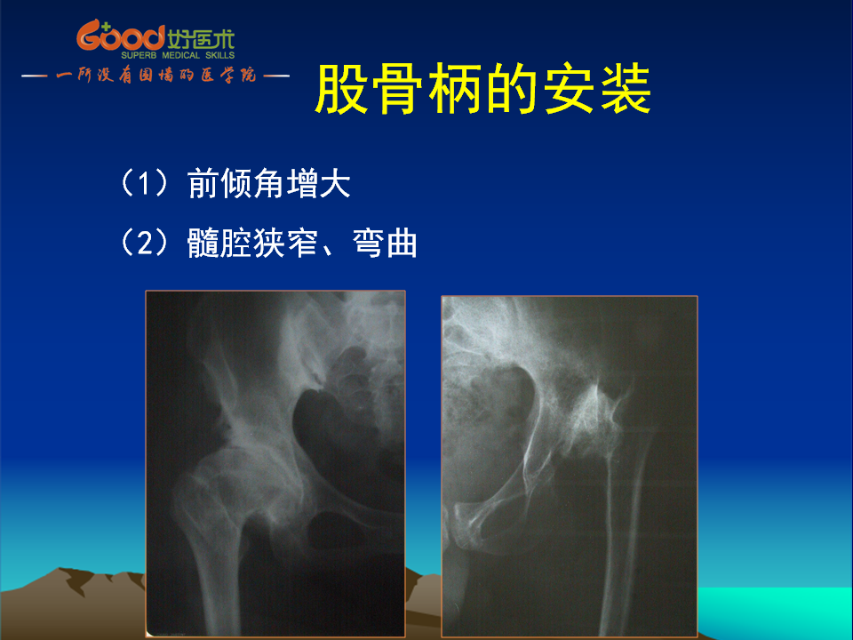 髋臼发育不良(DDH)手术策略